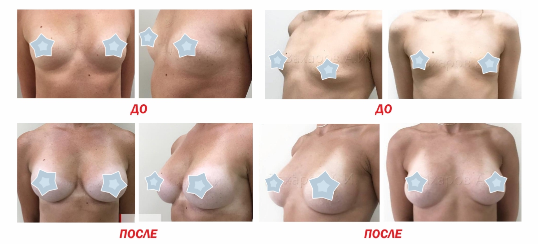 увеличение груди (маммопластика)